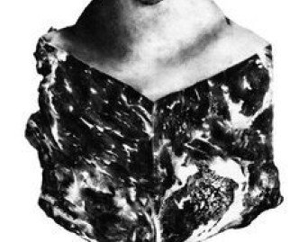 Transgender Dysphoria Blues